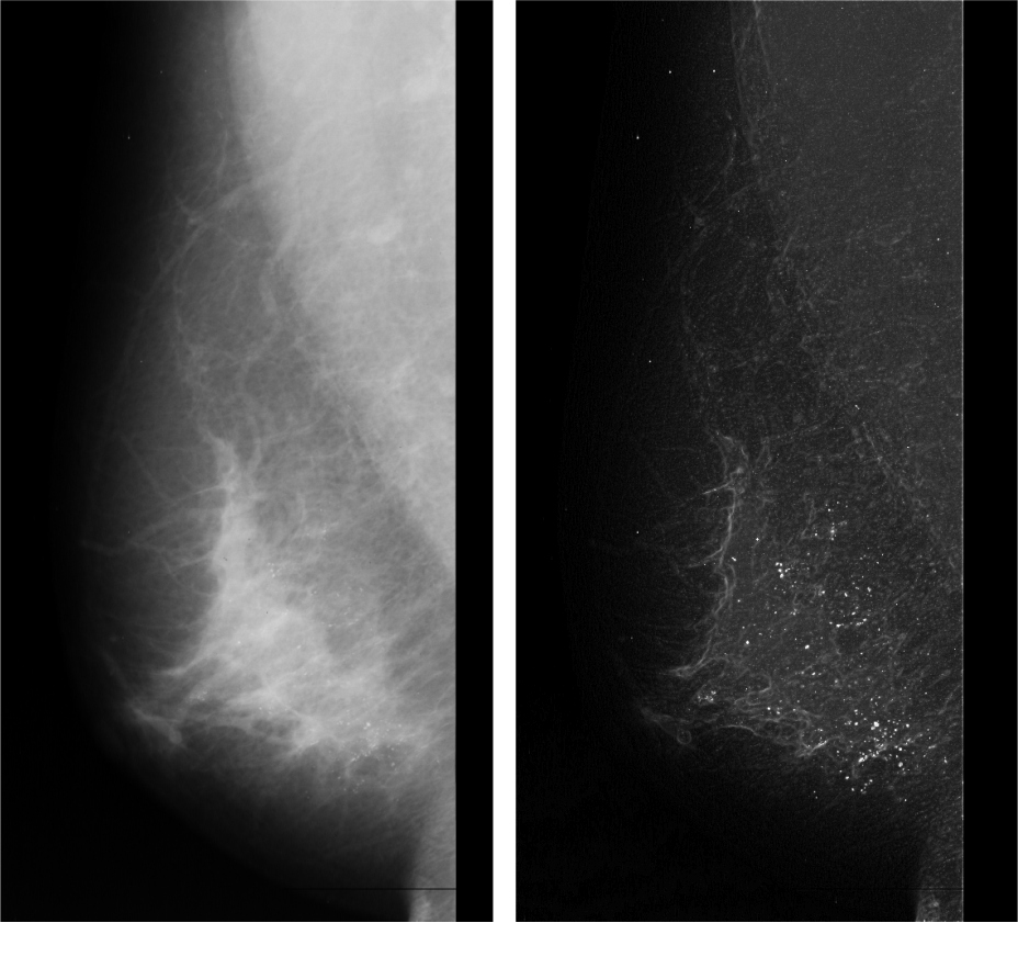 microcalcification